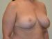 Breast Reduction After Patient Thumbnail 4