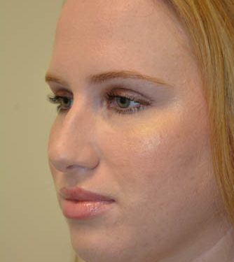 Rhinoplasty Before Patient 2