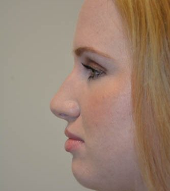 Rhinoplasty Before Patient 3