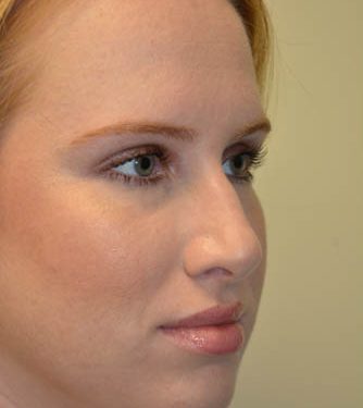 Rhinoplasty Before Patient 4