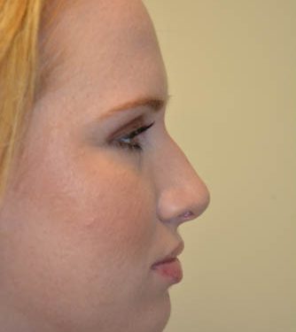 Rhinoplasty Before Patient 5