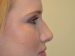 Rhinoplasty Before Patient Thumbnail 5