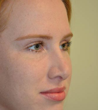 Rhinoplasty After Patient 4