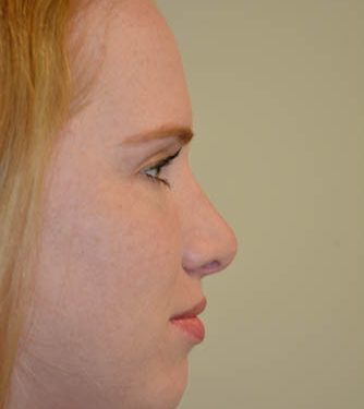 Rhinoplasty After Patient 5