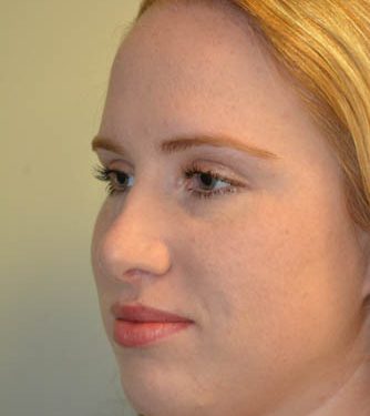 Rhinoplasty After Patient 2