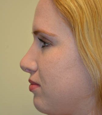 Rhinoplasty After Patient 3