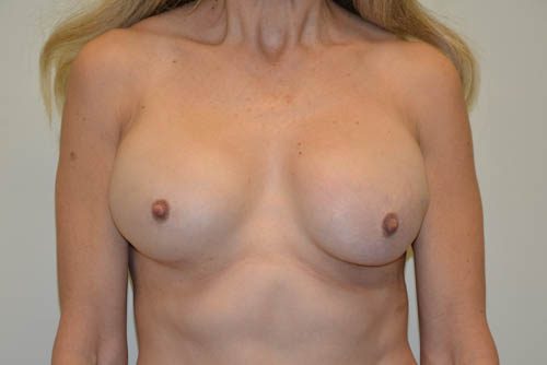 Breast Revision Before Patient 1