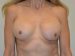 Breast Revision Before Patient Thumbnail 1