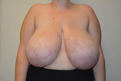 Breast Reduction Before Patient 1