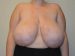 Breast Reduction Before Patient Thumbnail 1