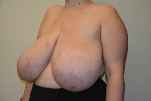 Breast Reduction Before Patient 2
