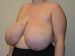 Breast Reduction Before Patient Thumbnail 2