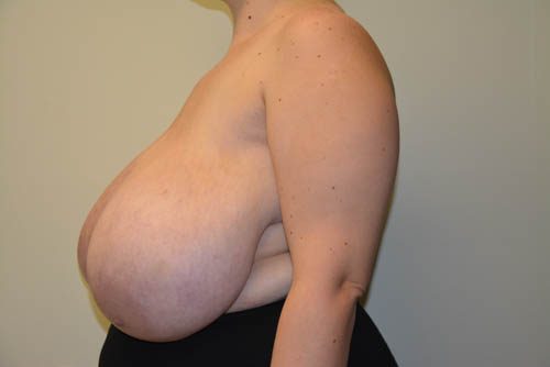 Breast Reduction Before Patient 3