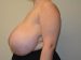 Breast Reduction Before Patient Thumbnail 3