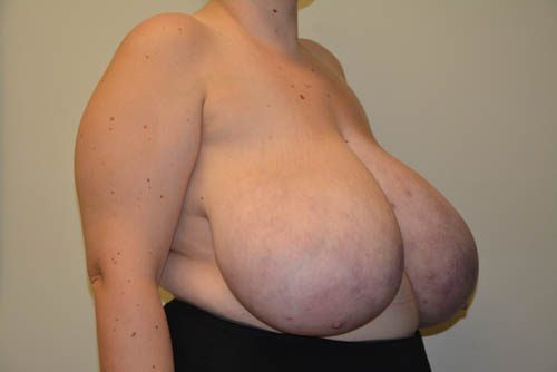 Breast Reduction Before Patient 4