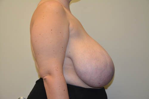 Breast Reduction Before Patient 5