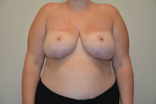 Breast Reduction After Patient 1