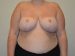 Breast Reduction After Patient Thumbnail 1