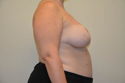 Breast Reduction After Patient 5