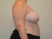 Breast Reduction After Patient Thumbnail 5