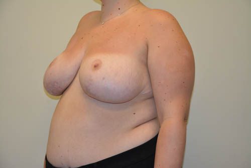 Breast Reduction After Patient 2