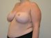 Breast Reduction After Patient Thumbnail 2