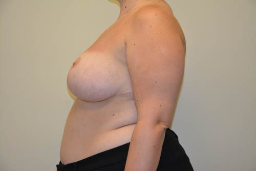 Breast Reduction After Patient 3