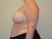 Breast Reduction After Patient Thumbnail 3
