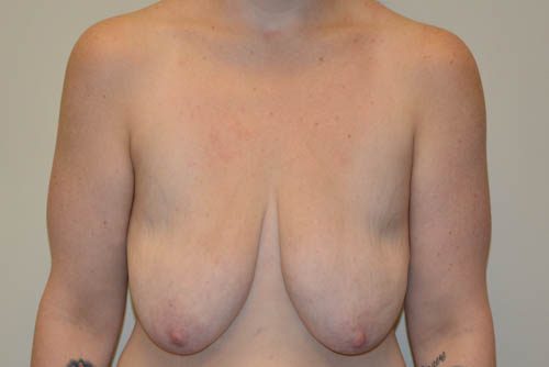 Breast Augmentation w/Lift Before Patient 1