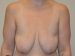 Breast Augmentation w/Lift Before Patient Thumbnail 1