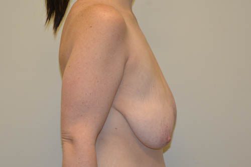 Breast Augmentation w/Lift Before Patient 5