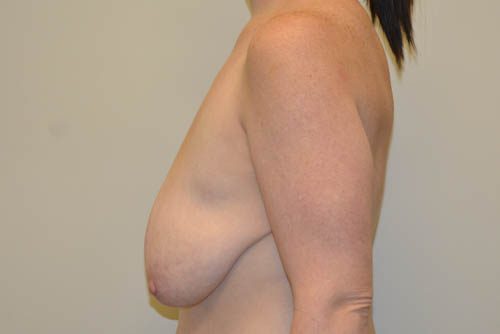 Breast Augmentation w/Lift Before Patient 3