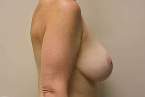 Breast Augmentation w/Lift After Patient 5