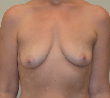 Breast Augmentation w/Lift Before Patient 1