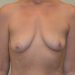 Breast Augmentation w/Lift Before Patient Thumbnail 1