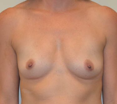 Breast Augmentation Before Patient 1