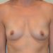 Breast Augmentation Before Patient Thumbnail 1