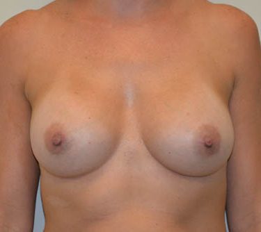 Breast Augmentation After Patient 1