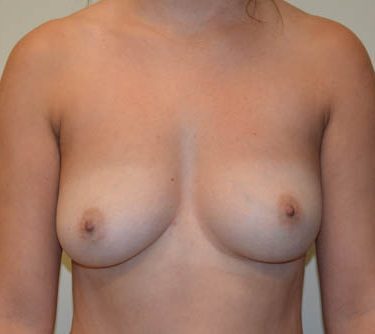 Breast Implant Removal After Patient 1