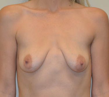 Breast Augmentation w/Lift Before Patient 1