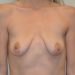 Breast Augmentation w/Lift Before Patient Thumbnail 1