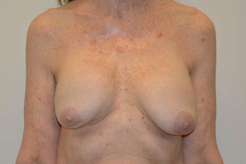 Breast Revision Before Patient 1