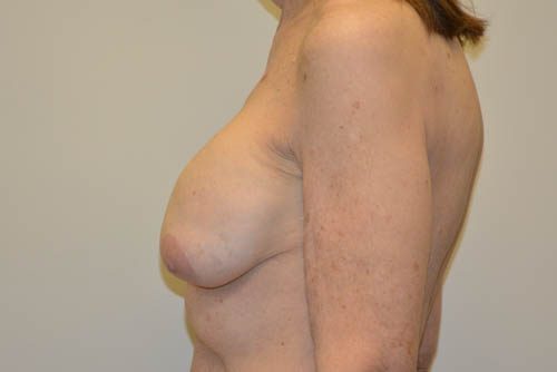 Breast Revision Before Patient 3