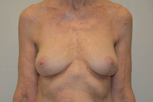 Breast Revision After Patient 1