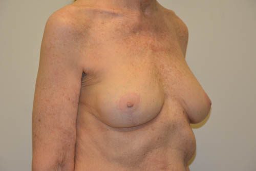 Breast Revision After Patient 4