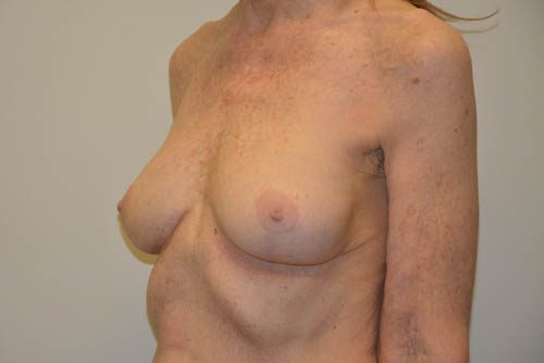 Breast Revision After Patient 2