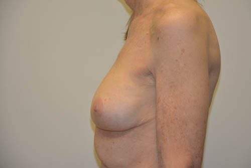 Breast Revision After Patient 3