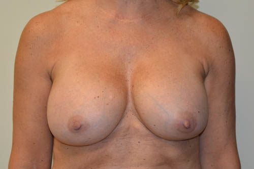 Breast Revision Before Patient 1