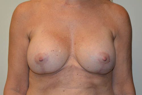 Breast Revision After Patient 1