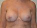 Breast Revision After Patient Thumbnail 1